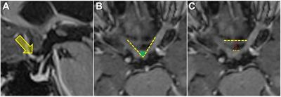Contralateral vs. Ipsilateral Approach to Superior Hypophyseal Artery Aneurysms: An Anatomical Study and Morphometric Analysis